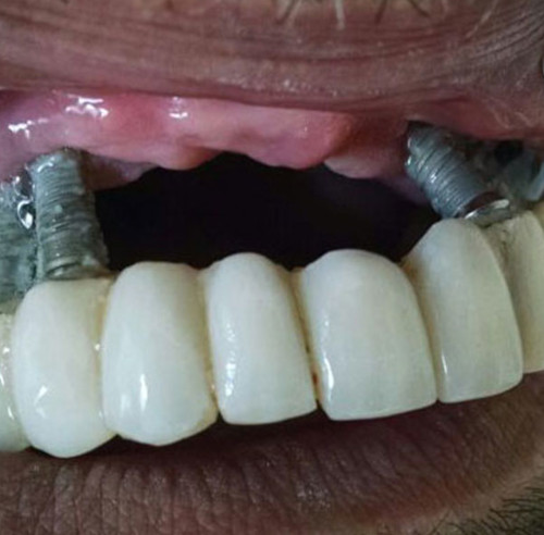 Péri implantite, rejet de l'implant dentaire définition et causes