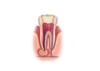 Incomplete root canal treatment technical picture