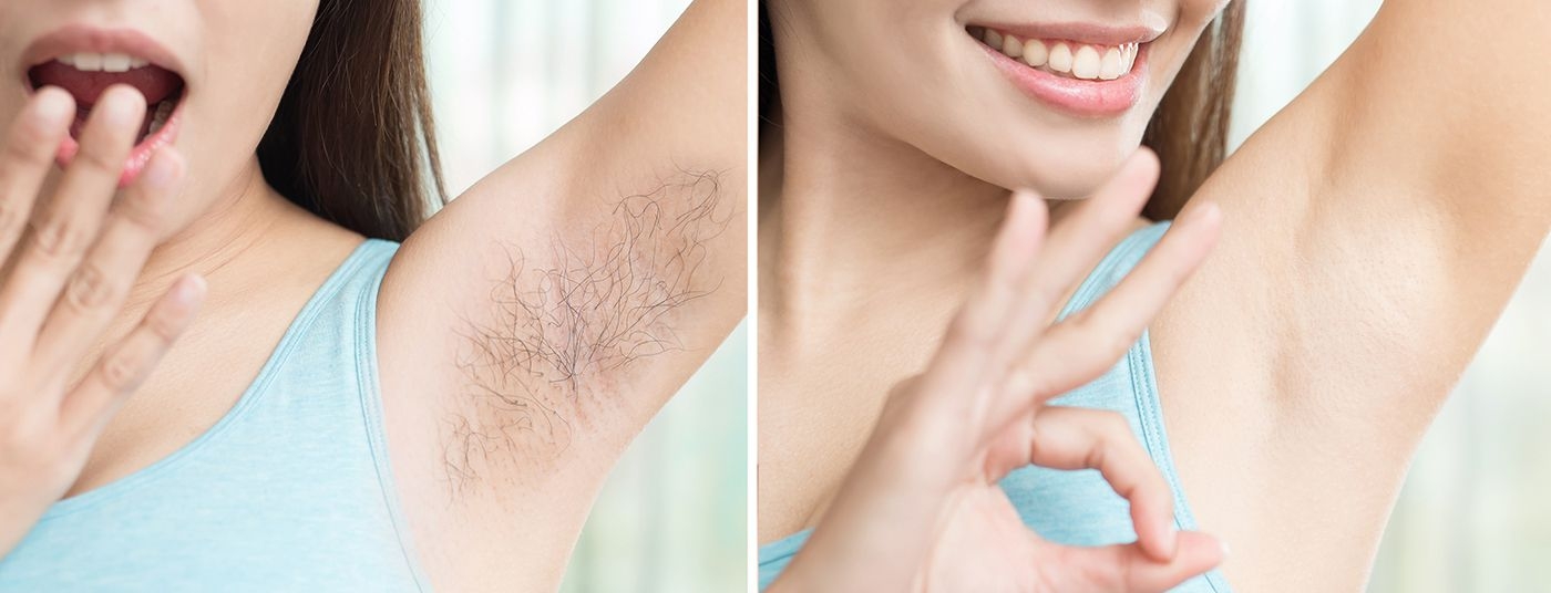 permanent-hair-removal before after