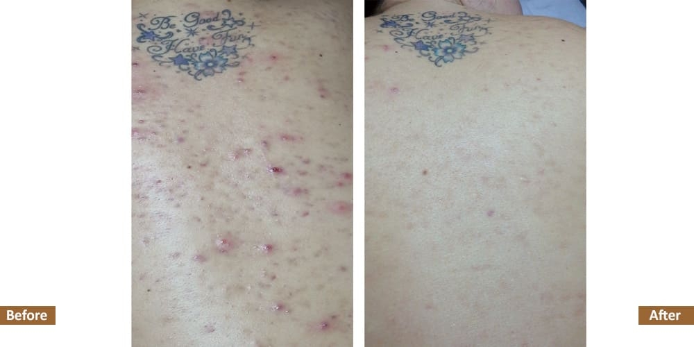 Before & After Back Acne Treatment