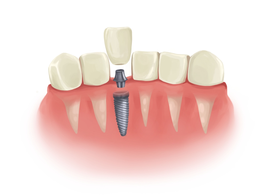 dental-implants-borough-dental-care-call-now-on-0207-407-3883