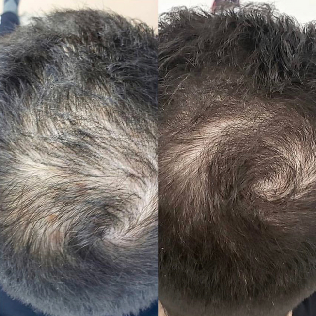 hair growth with PRP