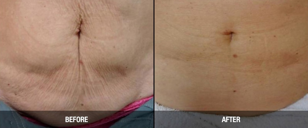 skin tightening before after
