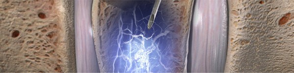 Tratament pentru compresiile vertebrale | Centrele Ares | Neuroradiologie Interventionala