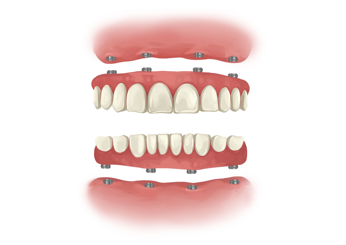 how much 3 on 6 dental implants cost