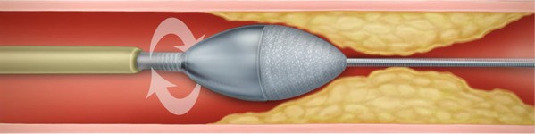 Rotablație | Centrele Ares | Inovatie in Cardiologie