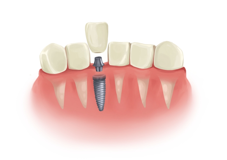 loose-dental-implant-causes-treatment-and-risks