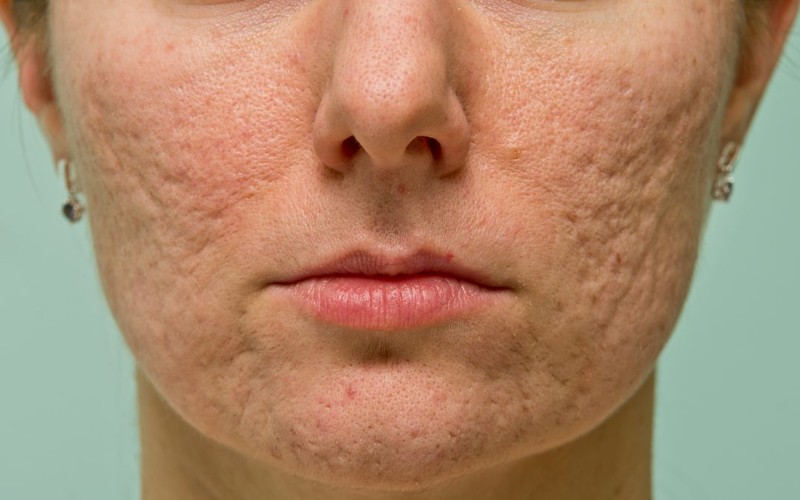 The Fastest Way to Clean Up Acne Scars | Laser Acne Treatment