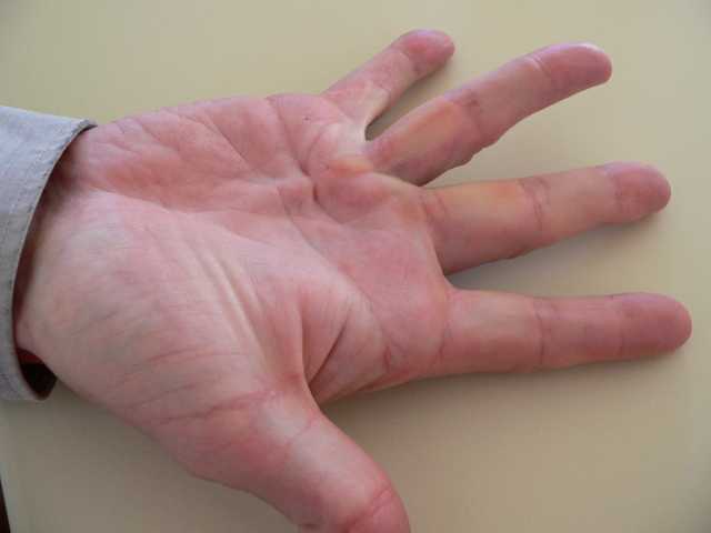Billede af begyndende strengdannelse og billede af håndens bindevævshinde (from wikipedia)
