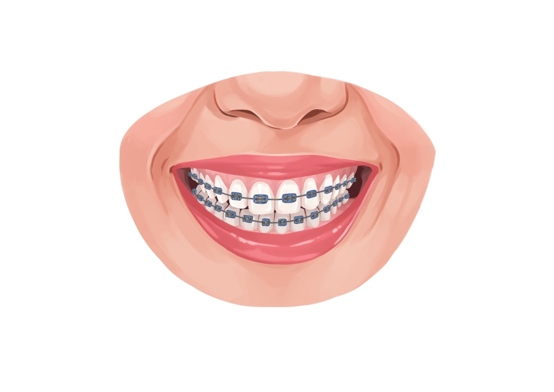 Open bite (anterior & posterior) causes and treatment Authority Dental