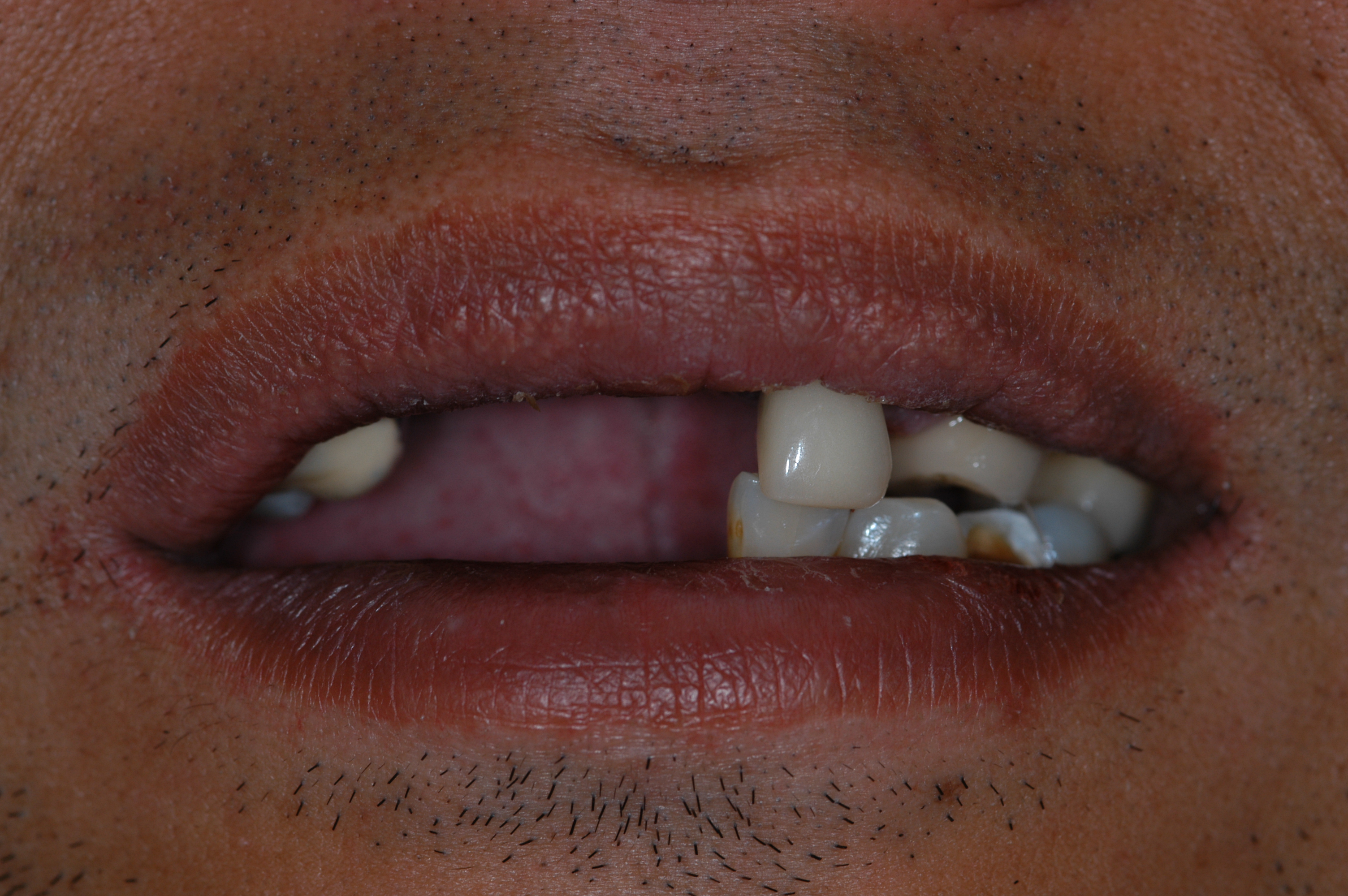 Before
