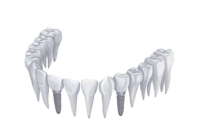 Teeth and implants model, without gums