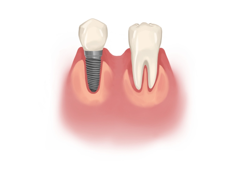 Dental implant vs. natural tooth