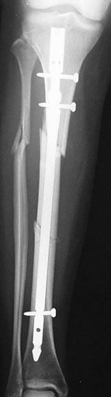 Tibia-Post.jpg