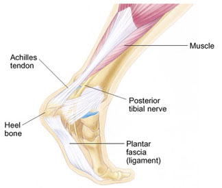 plantar fasciitis and achilles tendonitis together