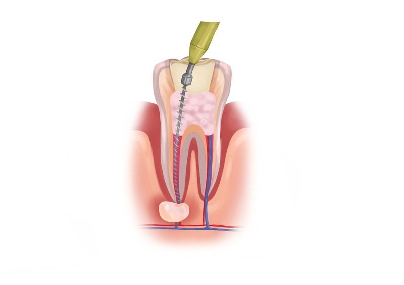Root canal retreatment 