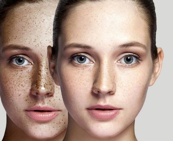 How to Get Rid of Skin Pigmentation