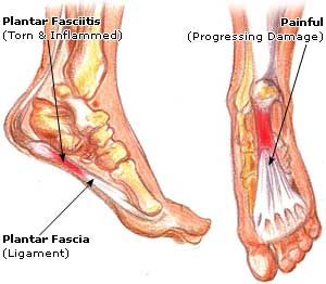"Plantar