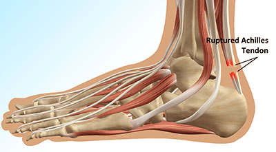 "Plantar