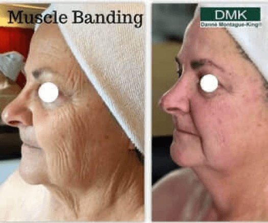 Muscle Banding with A-lift - Enzyme Masque #2 & #3