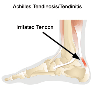 "Plantar