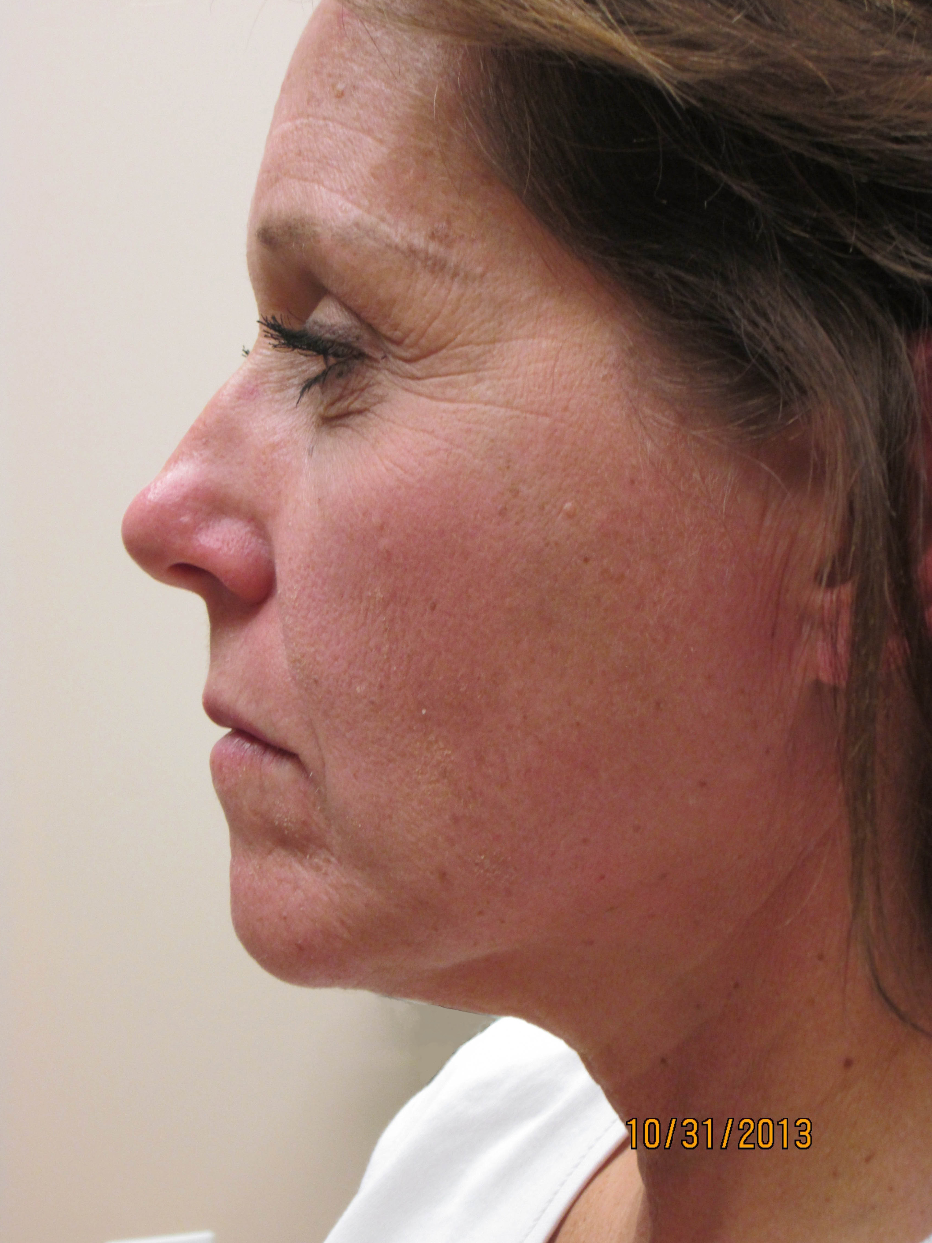 14172 2 pre profile facelift.JPG