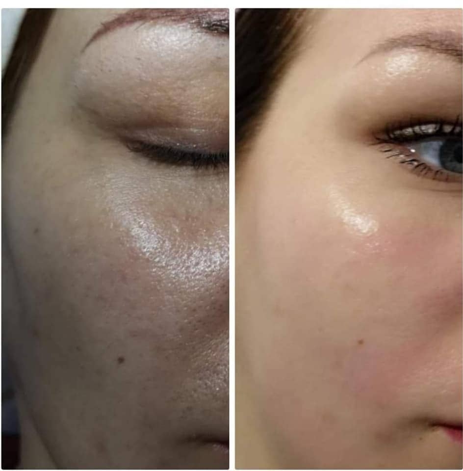 AnteAge Before & After Treatment