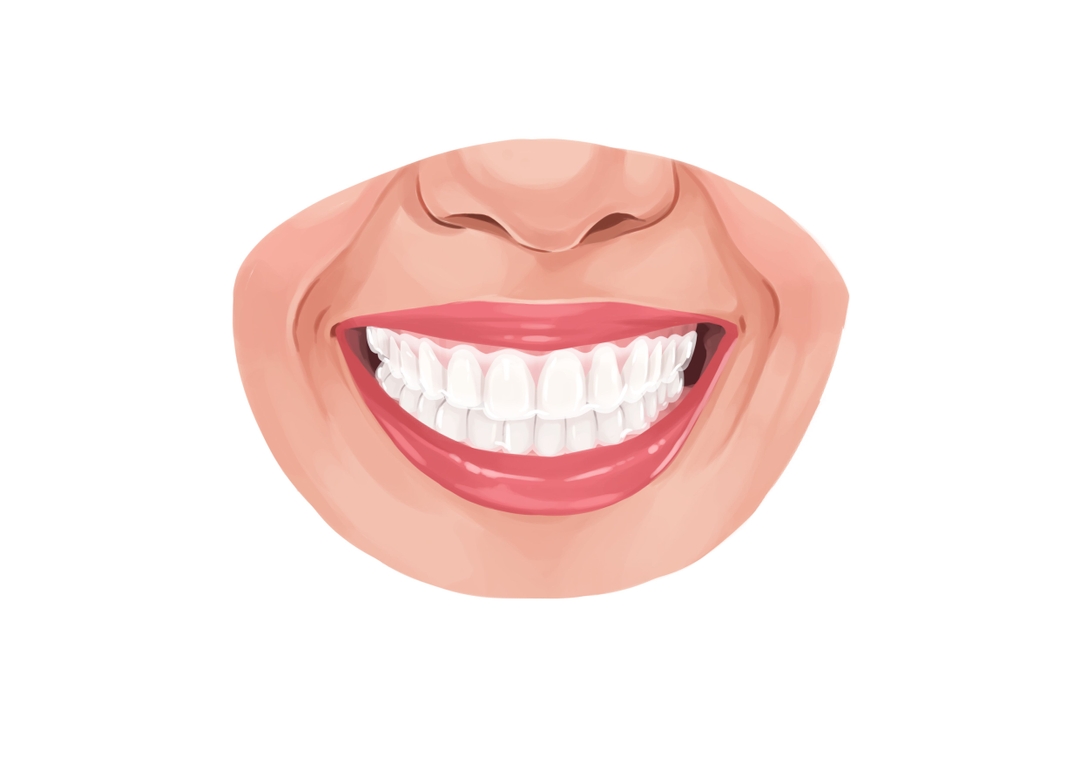 least expensive invisible braces