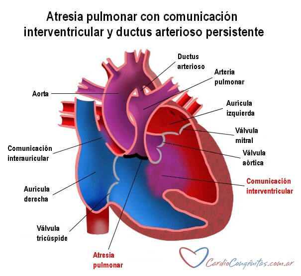 Atresia Pulmonar