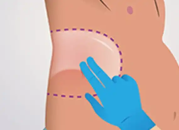 illustration of specialist applying Cleansing Gel to torso