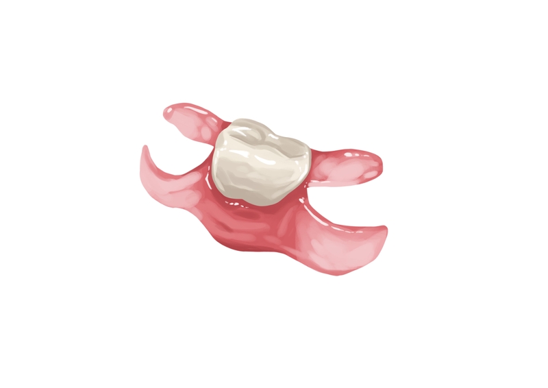 Flexible partial denture for lone missing tooth