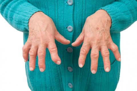 Información sobre la Artritis