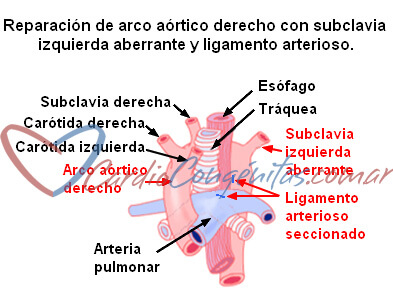 arco-ao-der-subcl-izq-aberr-cirugia