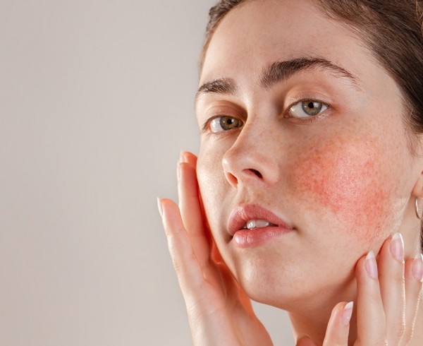 Top Causes and Treatments for Rosacea