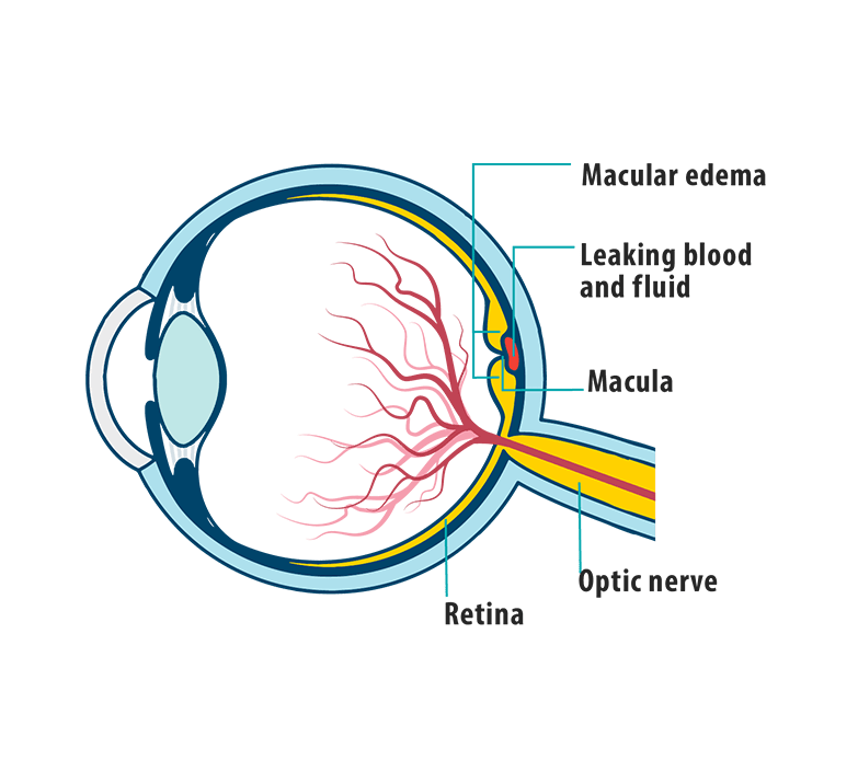 Understanding Wet Agerelated Macular Degeneration (Wet AMD)