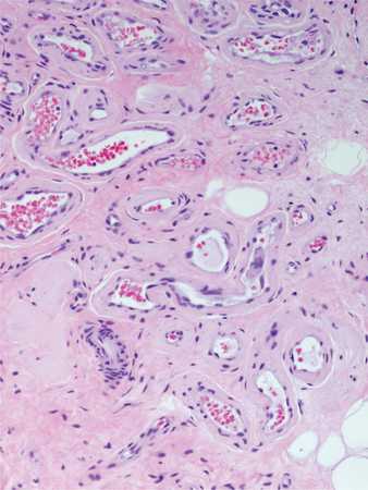 Hemangiom - cauze, simptome, tratament