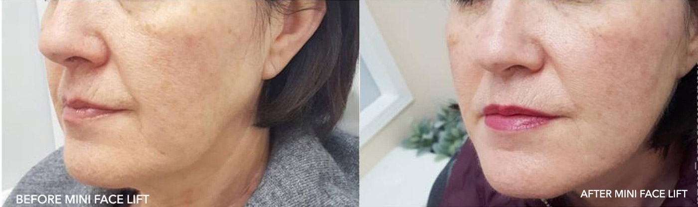FACESCULPTING BEFORE AFTER