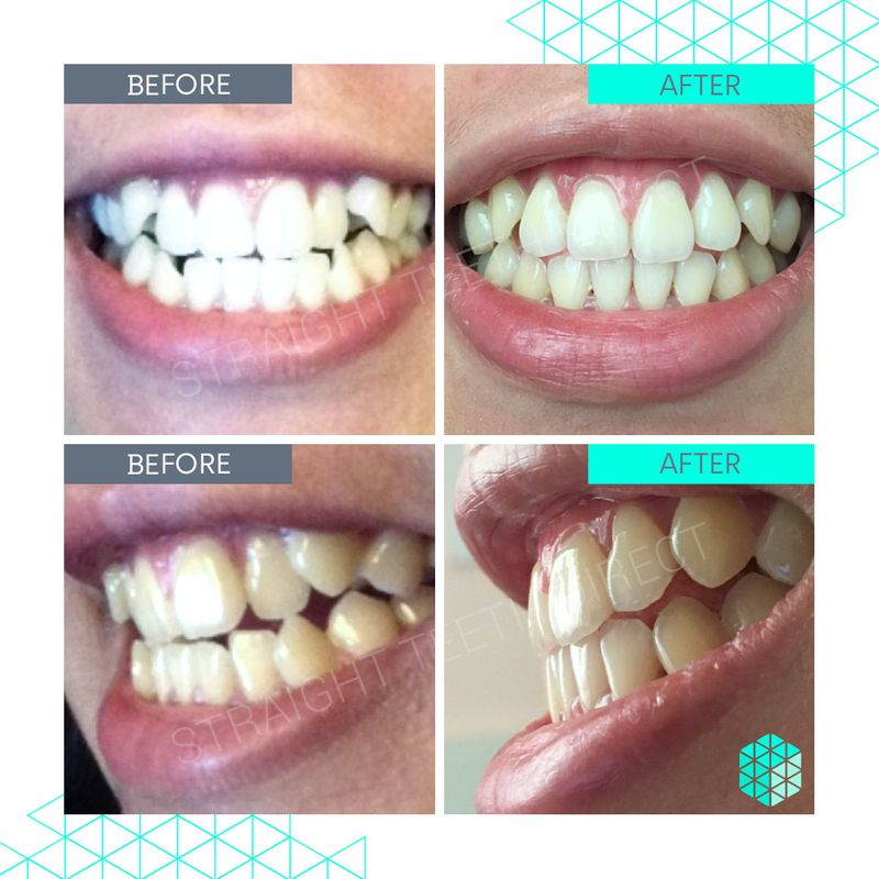 Straight Teeth Direct Reviews Real People Real Results