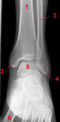 Ankle radiograph - AP projection.