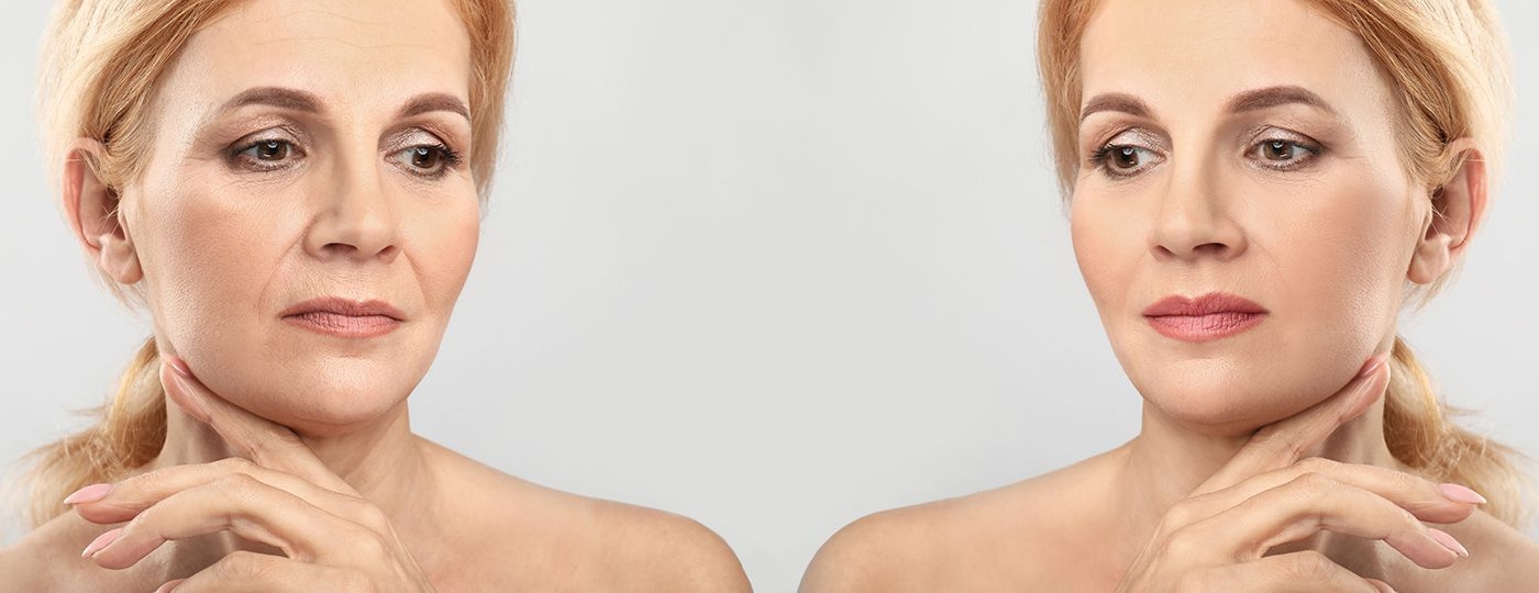 Botox Treatment in thornhill before after