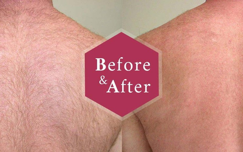 Laser Hair Removal before after