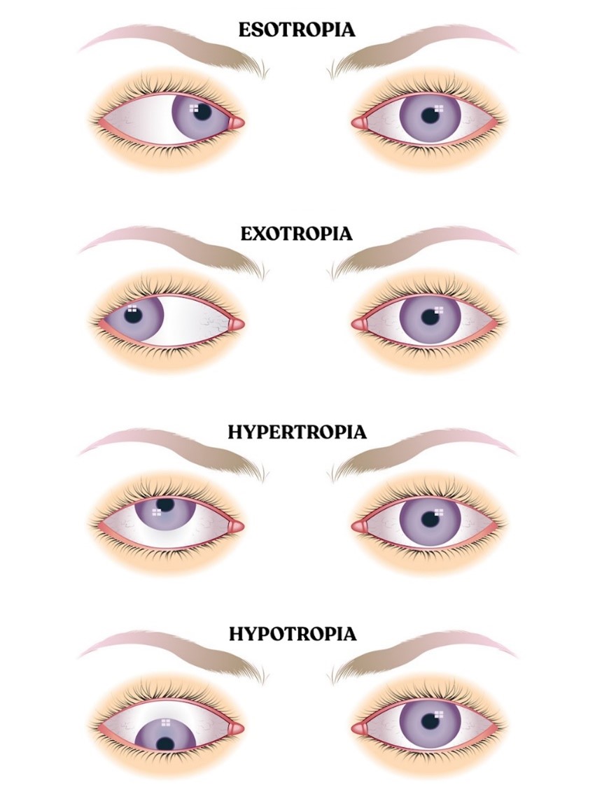 Amblyopia Innovative Eye Care