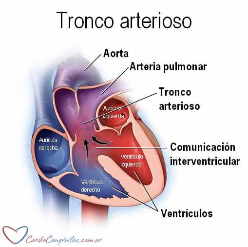 Tronco-arterioso-esquema