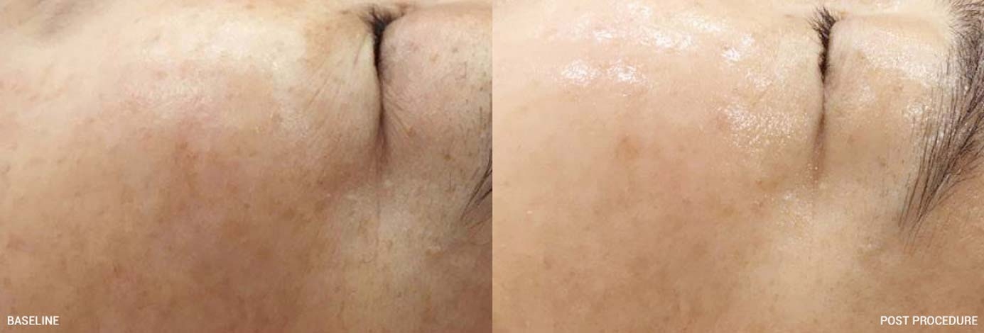 Results from Microdermabrasion