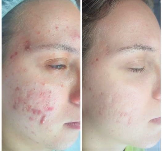 Cystic Acne Treatment Ottawa - Treat Inflammation, Lesions & Scars