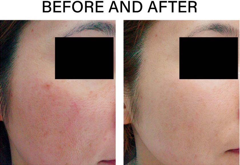 Before and after Laser Skin Treatments