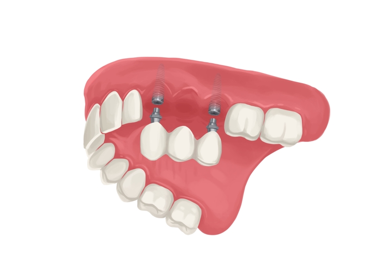 Implant supported bridge upper arch