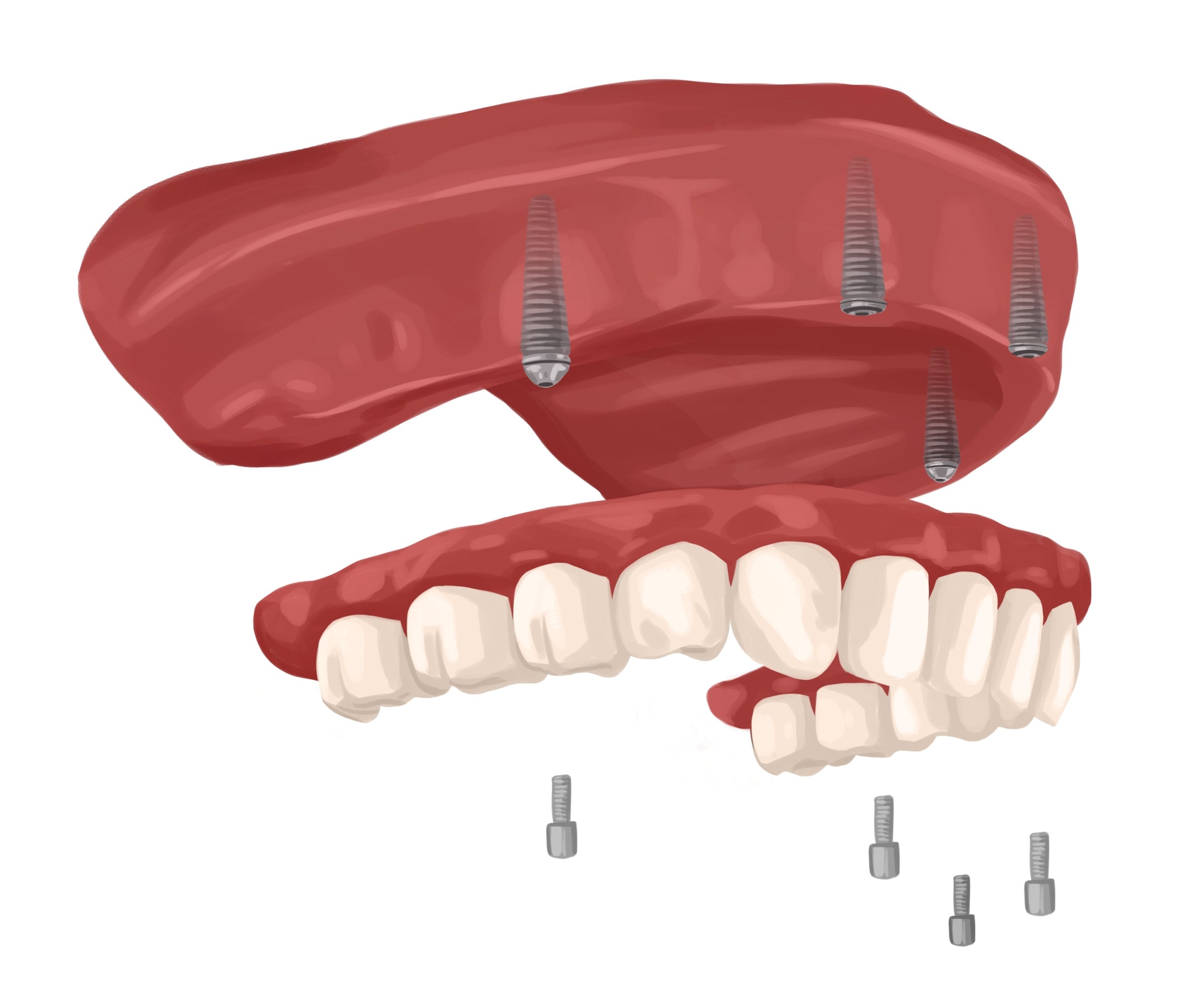 Dental implants