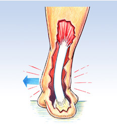 "Plantar