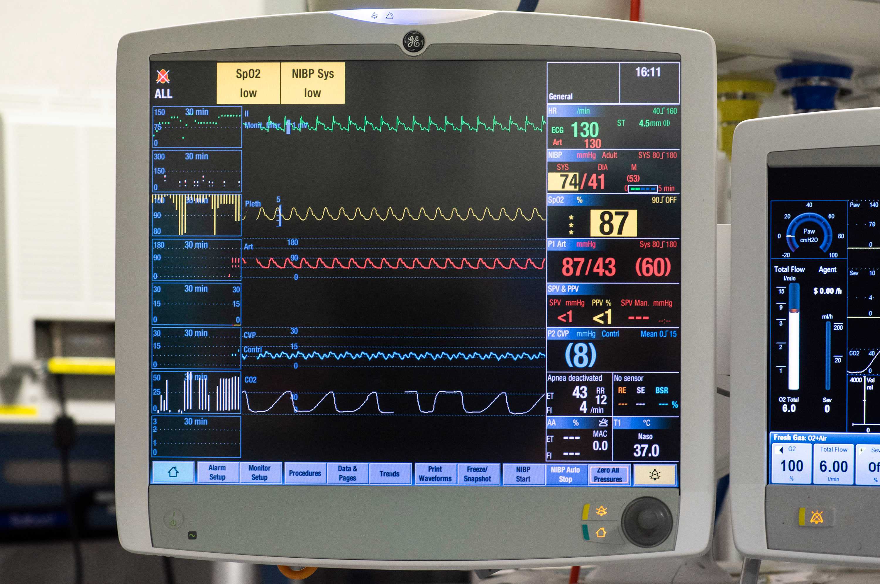 Multiple waveforms simulating a patient on actual clinical monitors.
